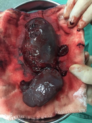 14歲男孩玩耍摔倒，脾臟破裂，險(xiǎn)些喪命！