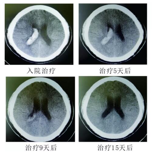 腦出血你不得不引起重視的疾?。。?！