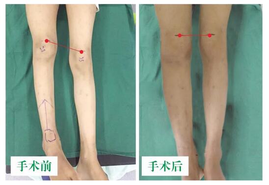 女孩墜梯右腿縮短5cm，幸得醫(yī)生及時診治恢復(fù)正常腿型