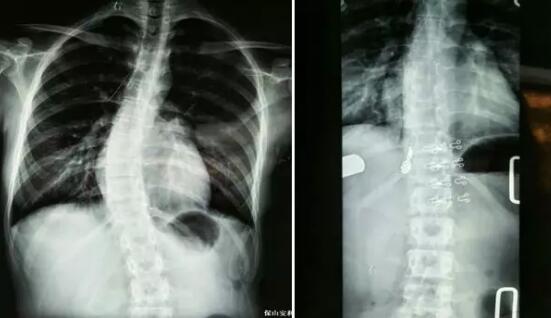 好好的脊柱怎么說彎就彎了？你竟然都沒發(fā)現(xiàn)……
