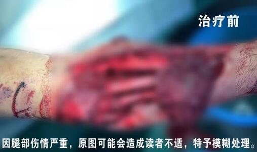 感謝安利醫(yī)院挽救了我的腿，沒有讓我落下殘疾……”