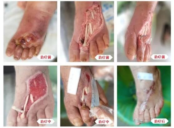 糖尿病并發(fā)癥有多可怕，及時治療糖尿病足避免截肢！