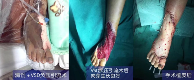 車禍猛如虎，救治如“華佗” ，手術(shù)＋康復(fù)，8歲小女孩車禍后日漸康復(fù)行走
