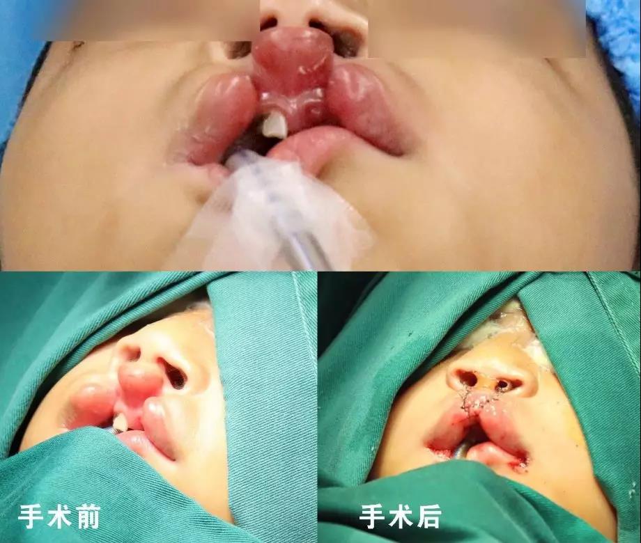 唇腭裂盡早治療消除孩子自卑心理，快樂(lè)成長(zhǎng)！