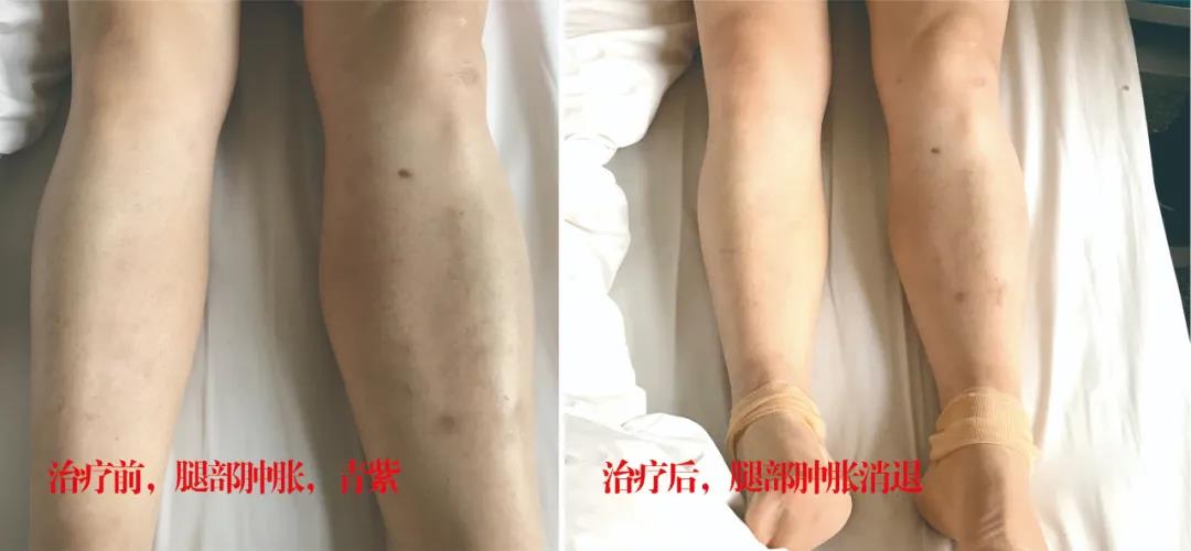 下肢靜脈血栓多年頑疾反復(fù)腫痛——疾病不容等待，早治療，早健康！