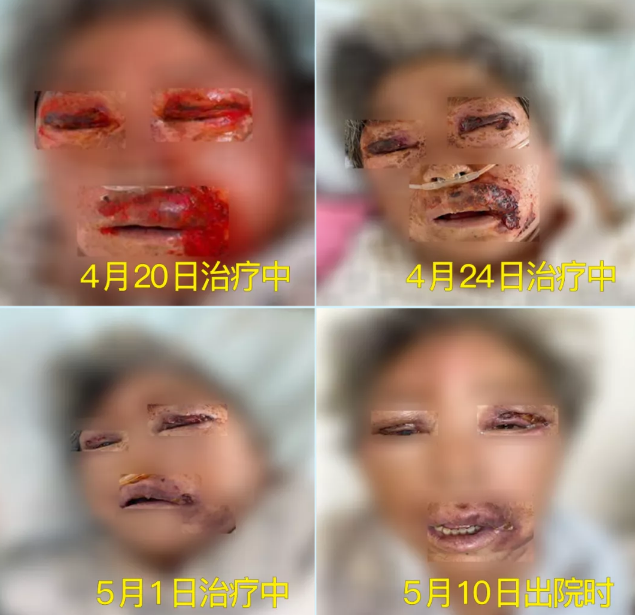 膿毒血癥（急性頜面部蜂窩組織炎）多學(xué)科聯(lián)合會(huì)診，幫助患者成功治愈！