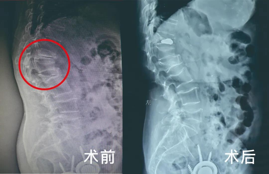 骨質疏松導致壓縮性骨折微創(chuàng)手術療效顯著