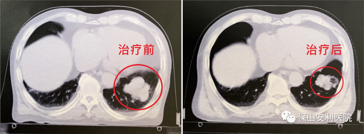 不做手術(shù)，早期肺癌也能根治！