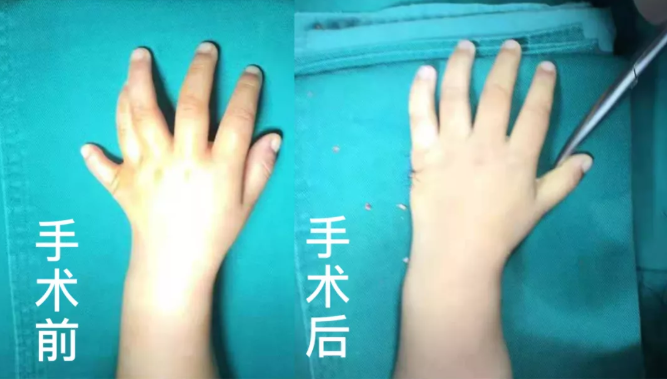 【保山安利醫(yī)院】2歲小兒手、足多指（趾）成功修復(矯正）！