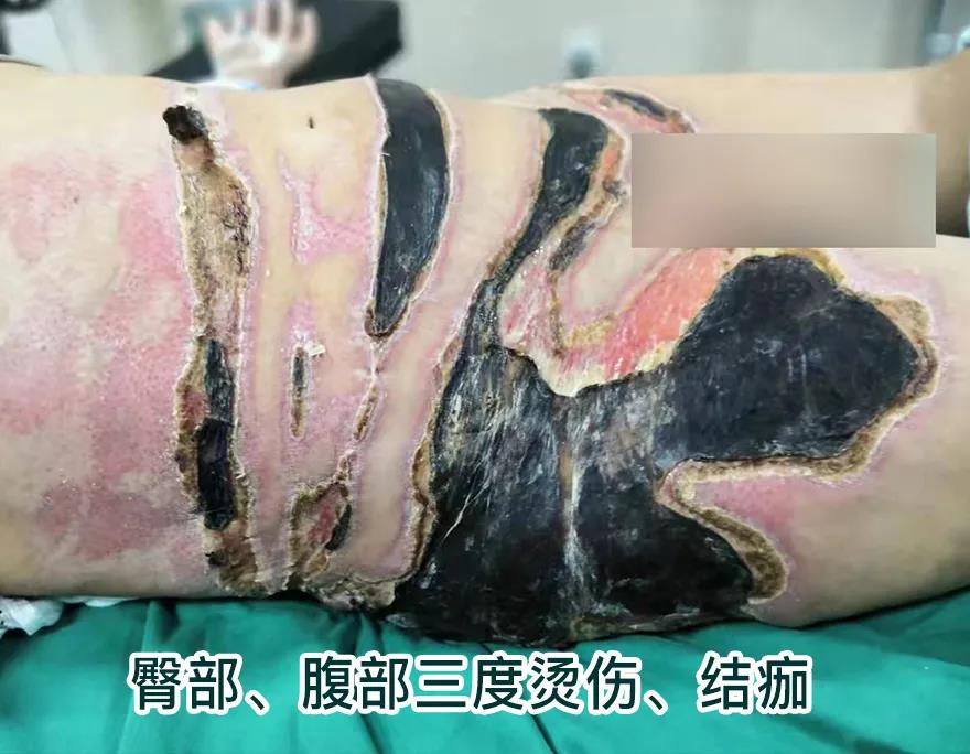 【保山安利醫(yī)院】80歲老人不慎燒傷，導(dǎo)致腹部、右側(cè)臀部大面積創(chuàng)傷，經(jīng)植皮治療創(chuàng)面逐漸愈合