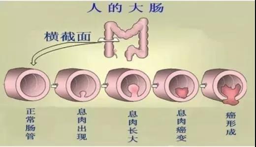 體檢發(fā)現(xiàn)腸息肉會(huì)癌變嗎？