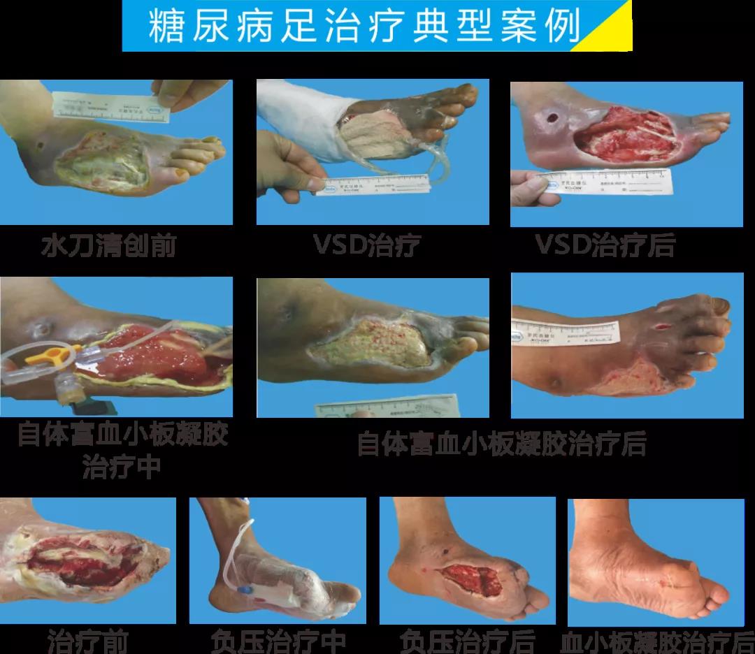 截肢、失明，甚至……，我們要做的是將糖尿病并發(fā)癥遏制在搖籃里！