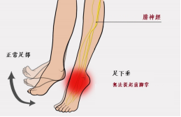 【保山安利醫(yī)院—健康科普】什么是足下垂！你了解嗎？