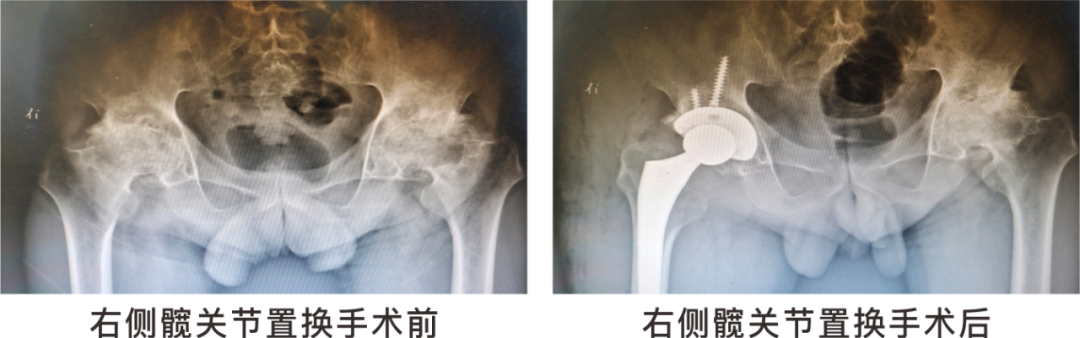 【保山安利醫(yī)院】長期飲酒導致雙側股骨頭壞死，髖關節(jié)置換后重獲運動功能！