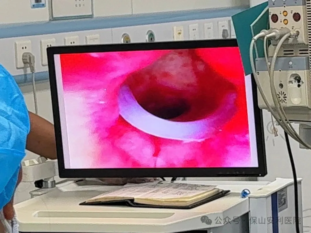 硬質支氣管鏡下硅酮支架置入術-為氣道塌陷患者撐開生命通道