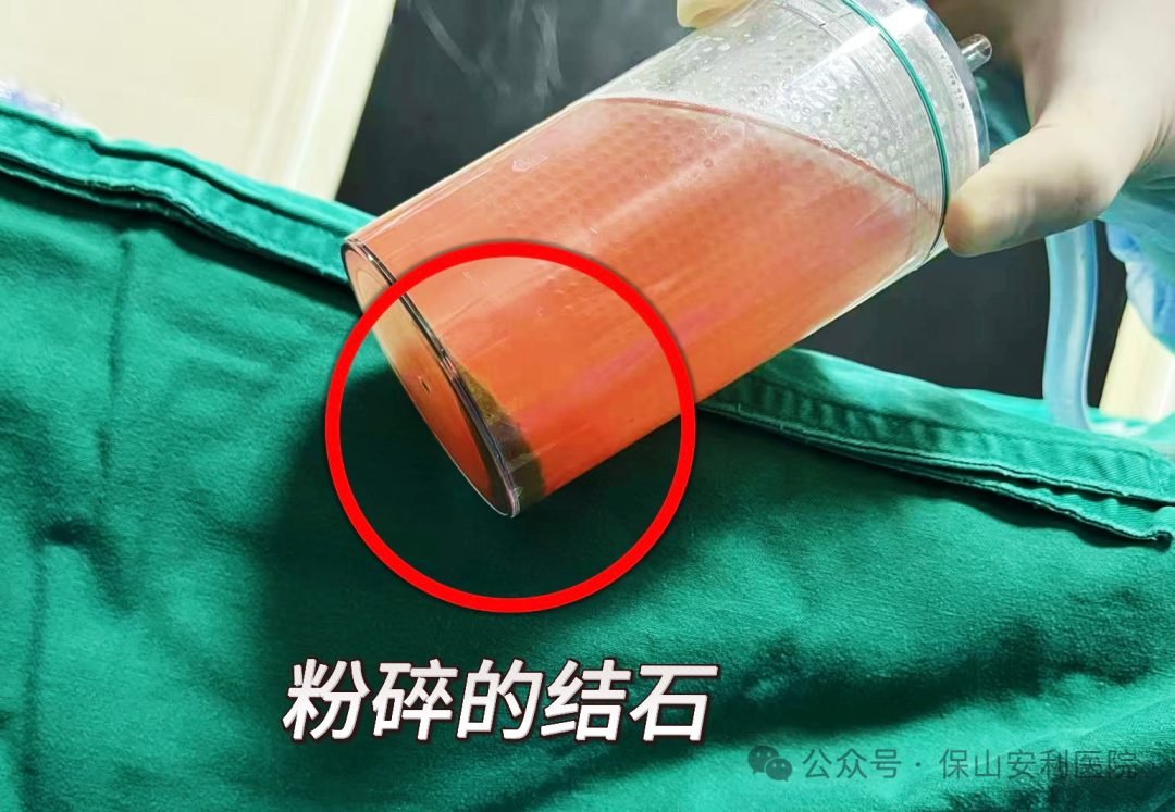 科普丨泌尿結(jié)石“克星”鈥激光碎石術(shù)，手術(shù)動(dòng)圖揭秘全過程！